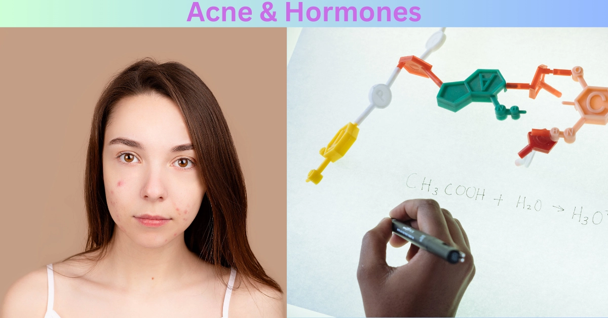 Acne & Hormones