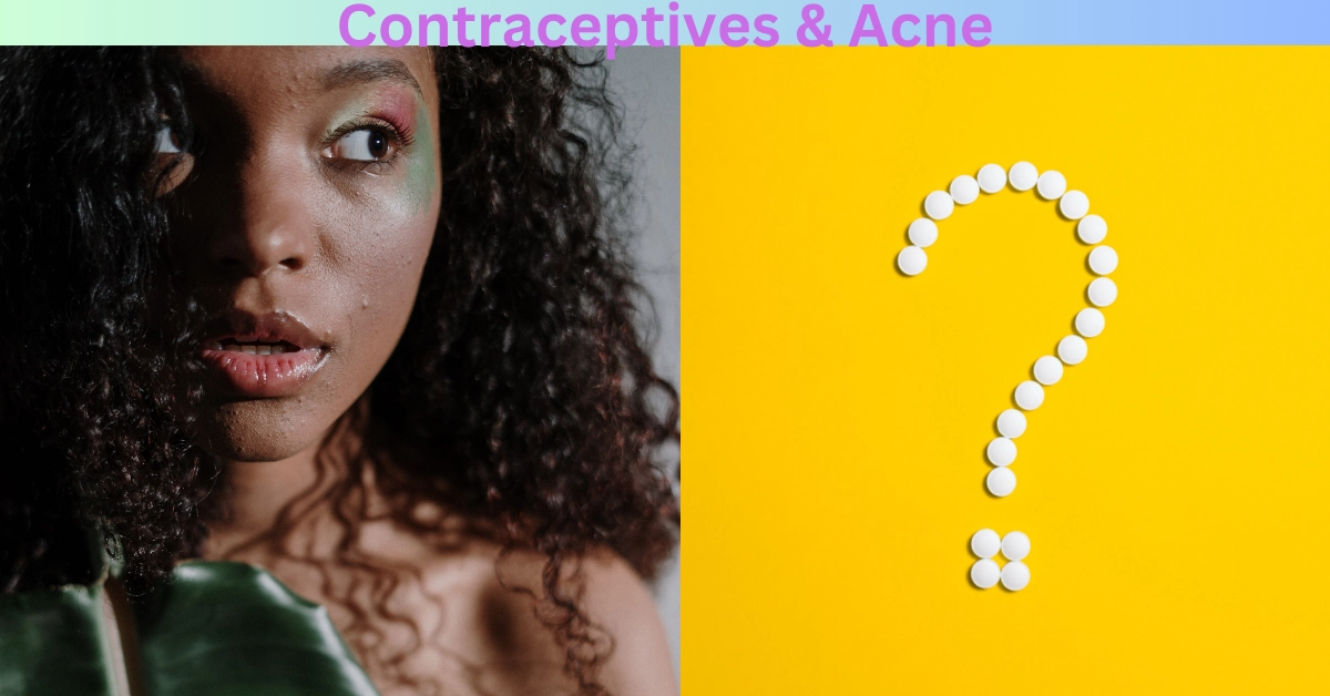 Contraceptives & Acne
