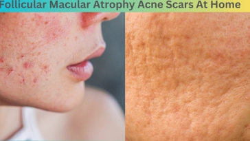 Follicular Macular Atrophy Acne Scars At Home