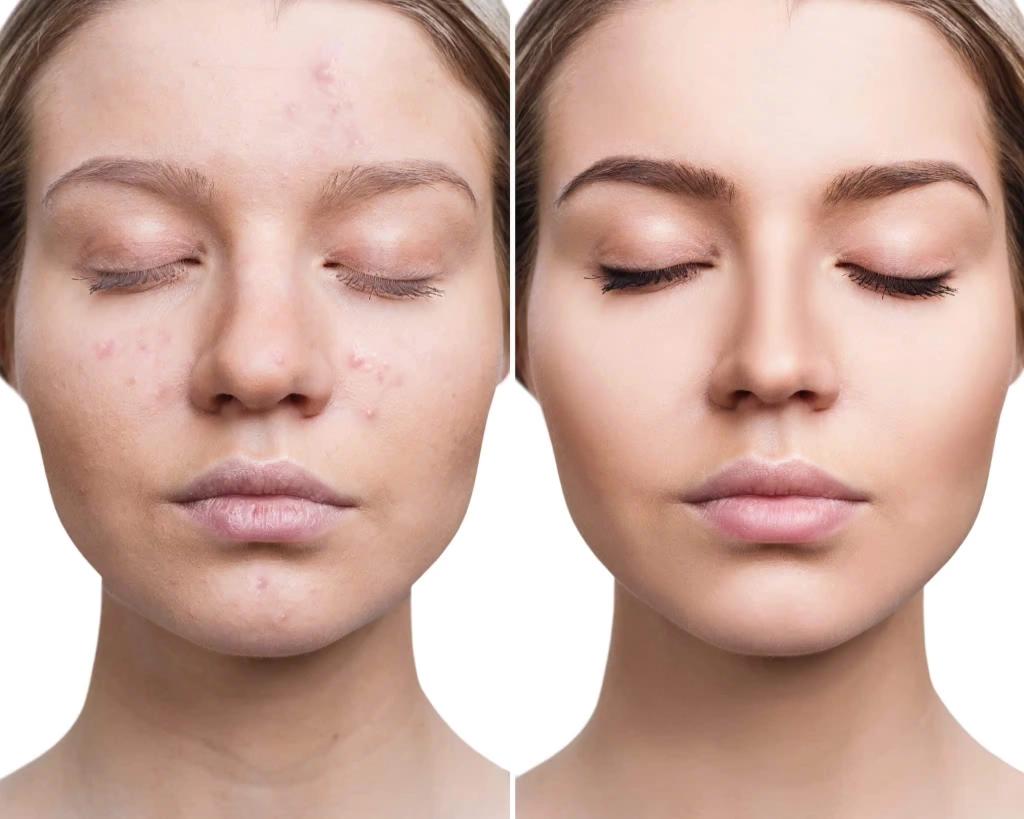 Prognosis and Complications of Acne 