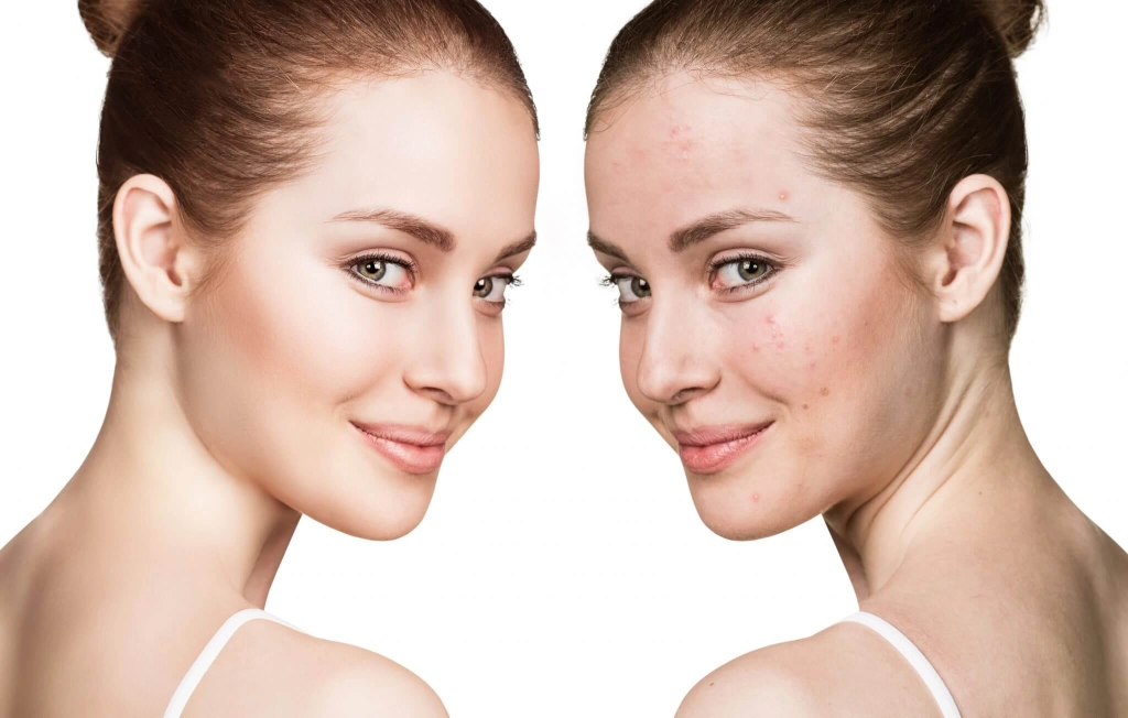Hormone Therapy as Acne Treatment